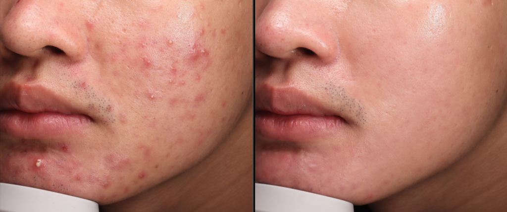 TRỊ MỤN CHUẨN Y KHOA THEO PHÁC ĐỒ CÁ NHÂN HÓA TỪ BÁC SĨ DA LIỄU