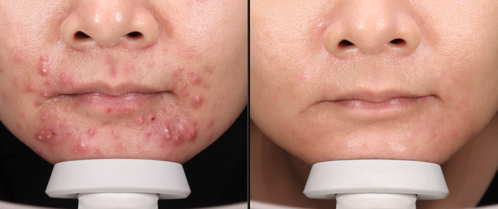 TRỊ MỤN CHUẨN Y KHOA THEO PHÁC ĐỒ CÁ NHÂN HÓA TỪ BÁC SĨ DA LIỄU