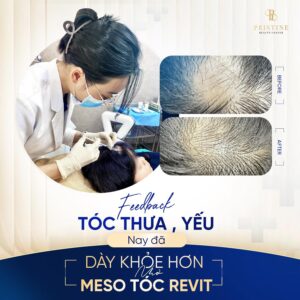 Liệu pháp PC mọc tóc kết hợp ánh sáng LED đa tầng