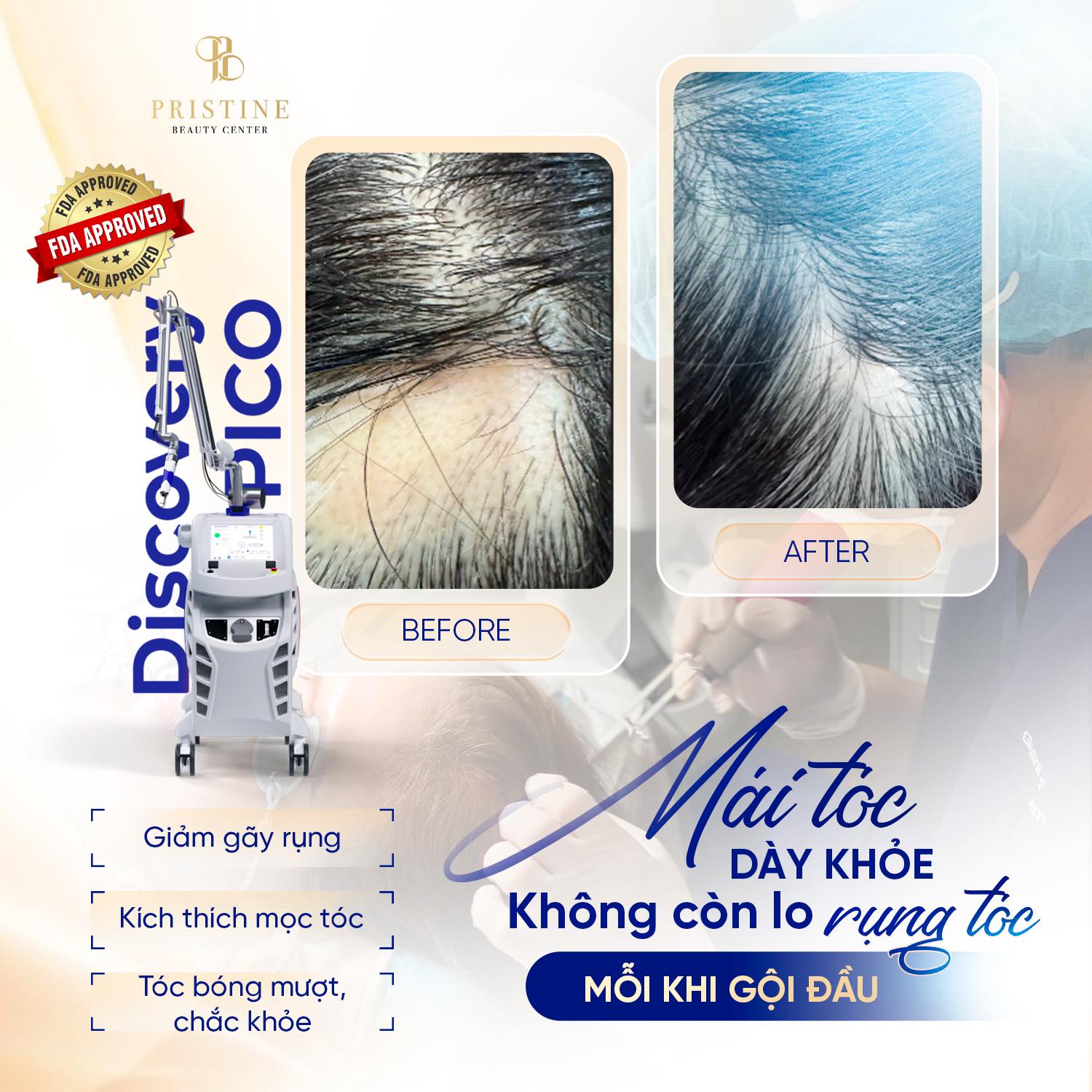 Nơi điều trị mọc tóc uy tín tại Biên Hòa - Phòng khám Da liễu Thẩm mỹ Pristine Beauty Center 4 Liệu pháp PC mọc tóc kết hợp ánh sáng LED đa tầng