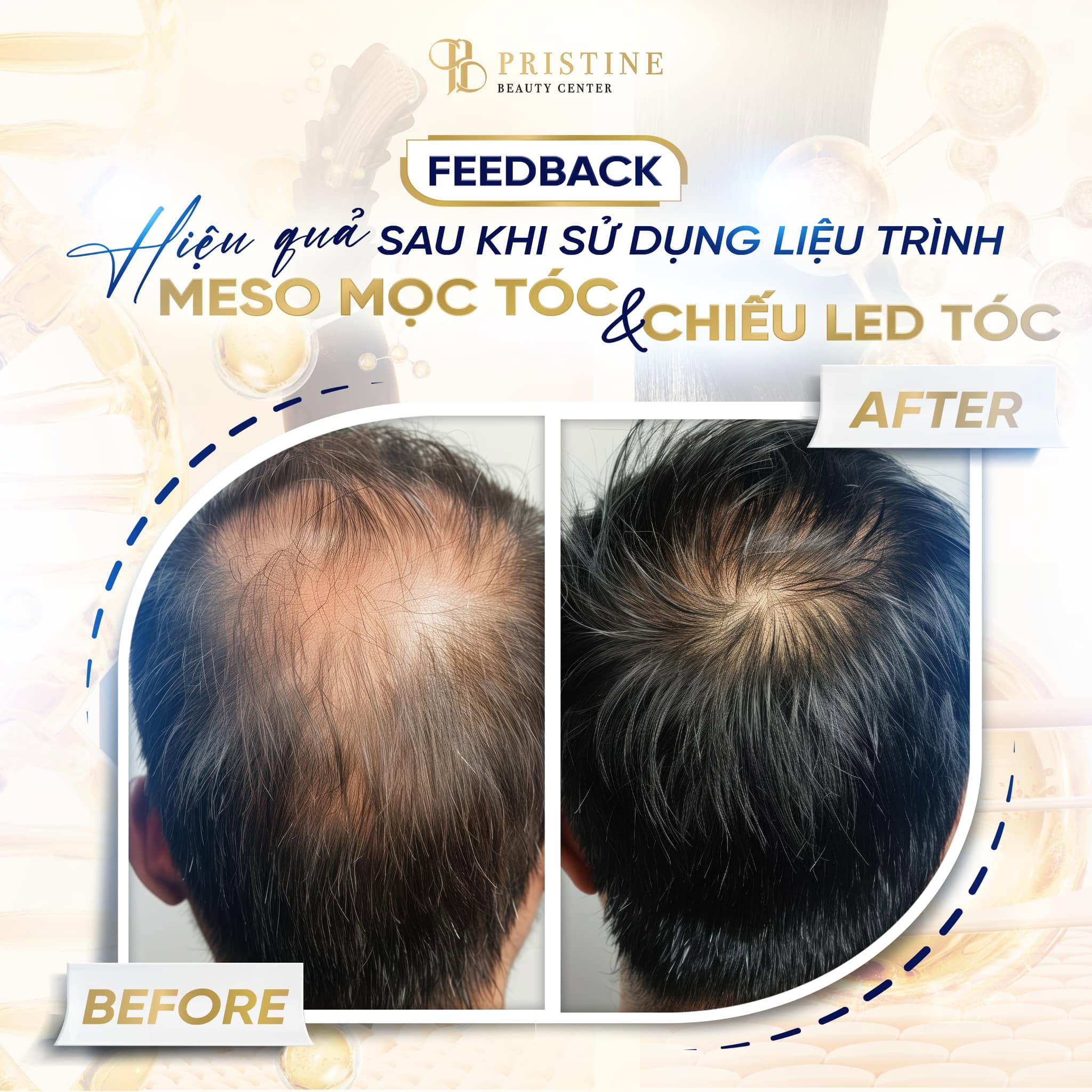 Nơi điều trị mọc tóc uy tín tại Biên Hòa - Phòng khám Da liễu Thẩm mỹ Pristine Beauty Center 3 Hiệu quả điều trị mọc tóc bằng Liệu pháp Mesotherapy
