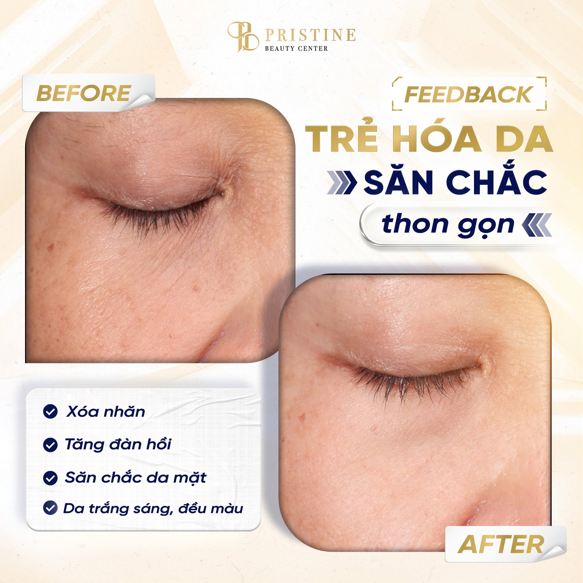 Trẻ hóa da không xâm lấn với RedTouch Pro - công nghệ xóa mờ dấu vết thời gian 5 Hiệu quả trẻ hóa da không xâm lấn với RedTouch Pro tại Pristine