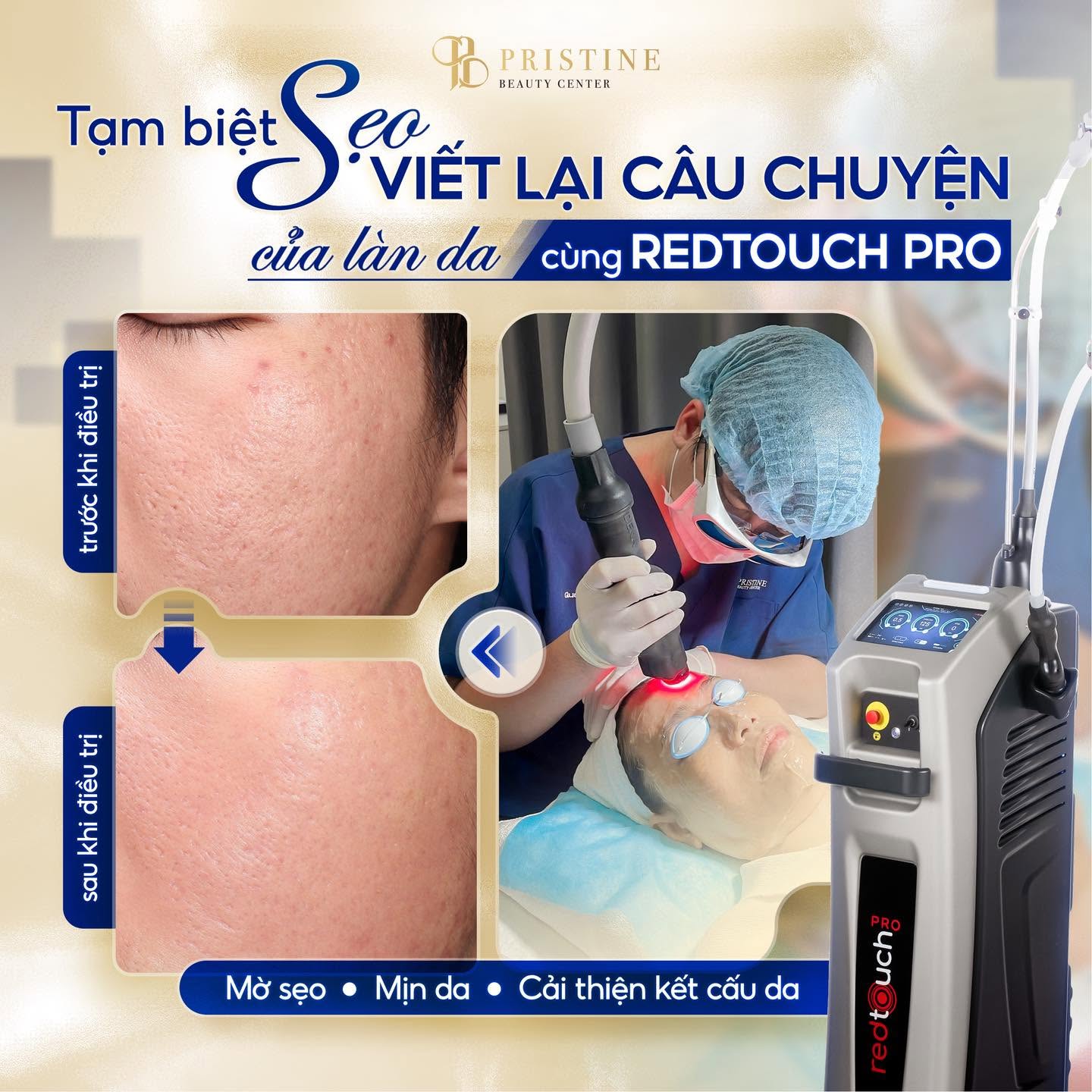 Điều trị trẻ hoá da kết hợp điều trị sẹo sau mụn