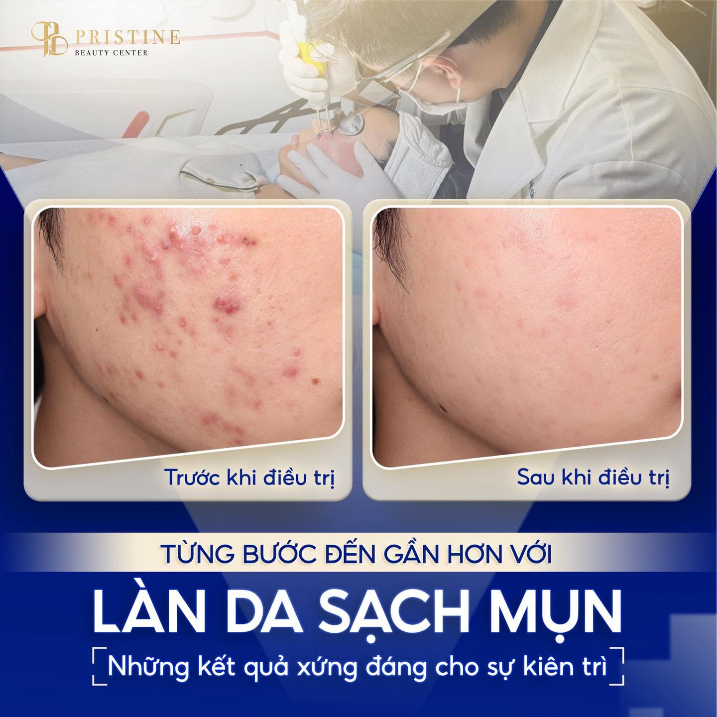 Loại bỏ vi khuẩn gây mụn