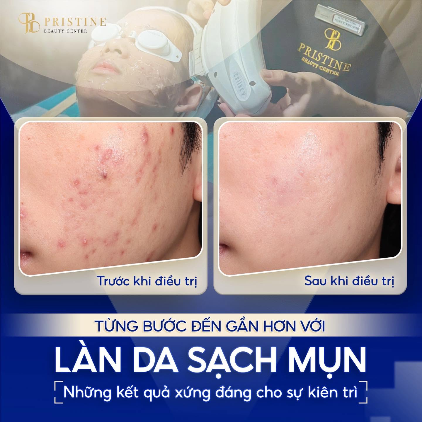 Laser trong điều trị mụn hoạt động Kiểm soát dầu thừa giúp lỗ chân lông luôn khô thoáng