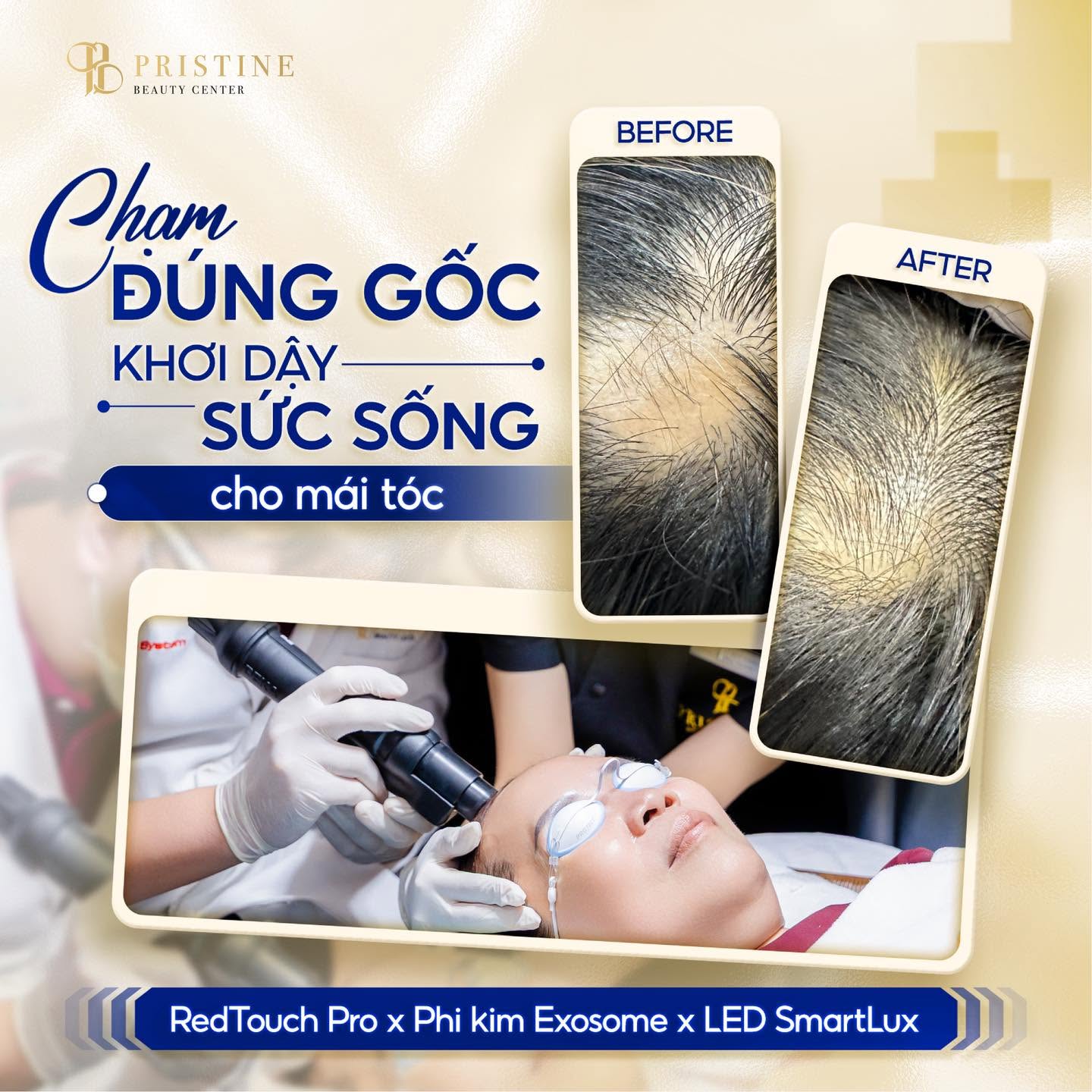 Hiệu quả điều trị rụng tóc sớm tại Trung tâm Da liễu Biên Hoà Pristine