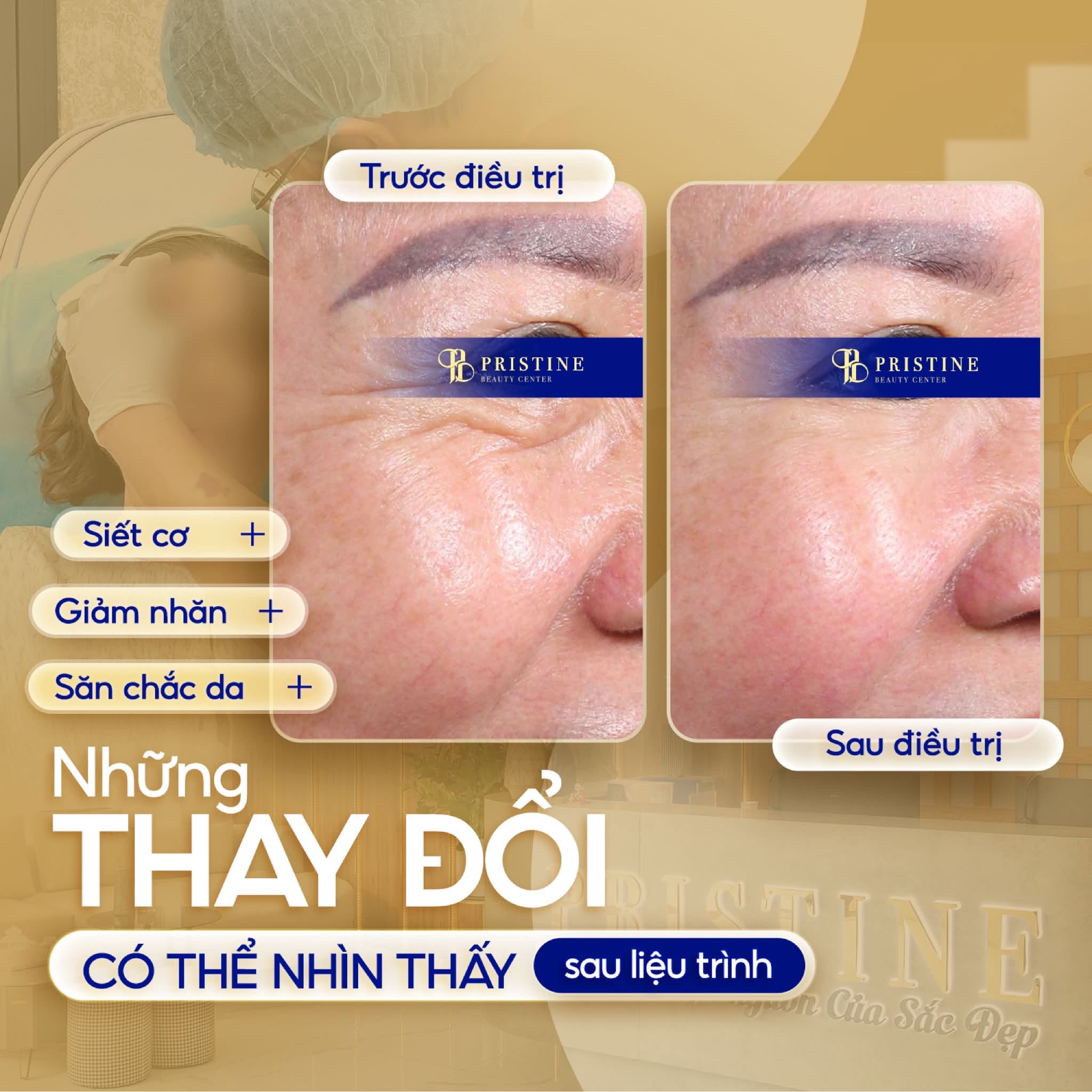 Các công nghệ nâng cơ không phẫu thuật hiện nay: MFU, HIFU, RF khác gì nhau? 4 RF hỗ trợ cải thiện độ săn chắc và đàn hồi của da