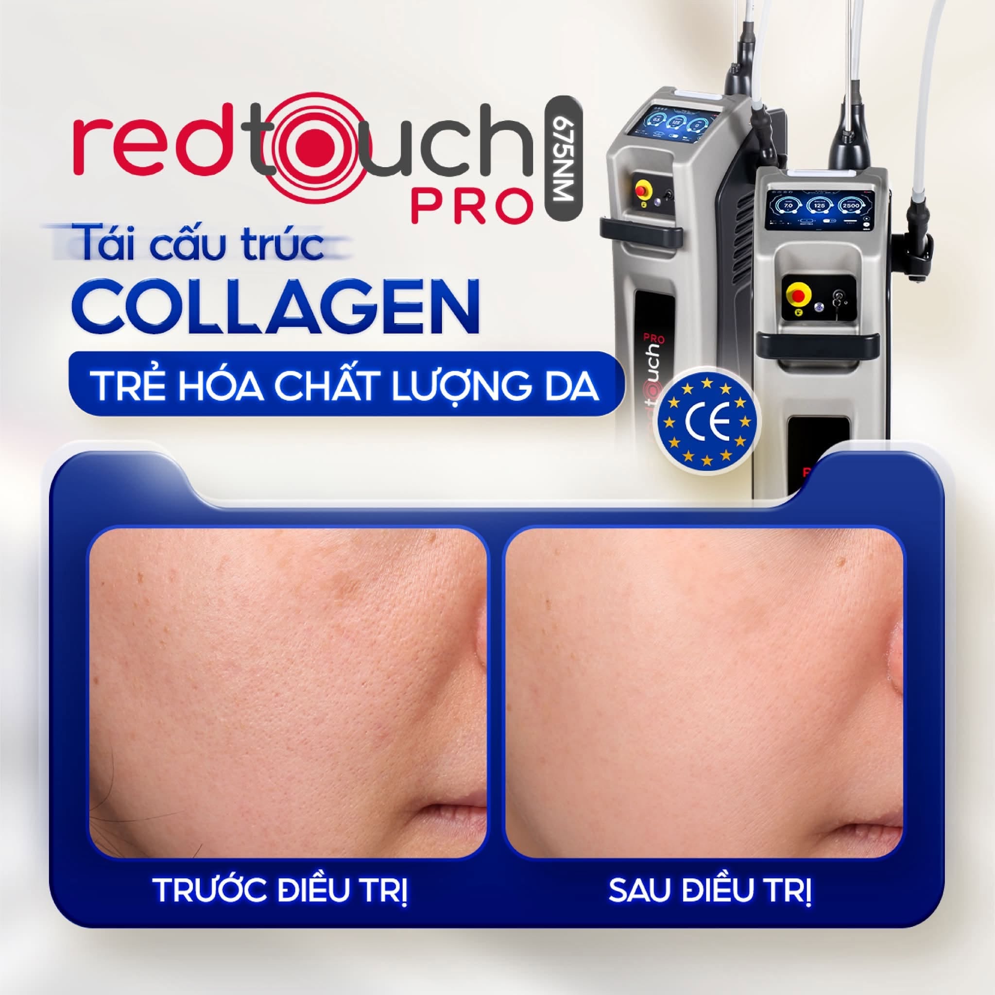 Nâng cơ trẻ hóa da tại Biên Hòa: Phòng khám nào có công nghệ xịn nhất? 8 Công nghệ laser xung ngắn hỗ trợ xử lý các vấn đề sắc tố, cải thiện tình trạng da