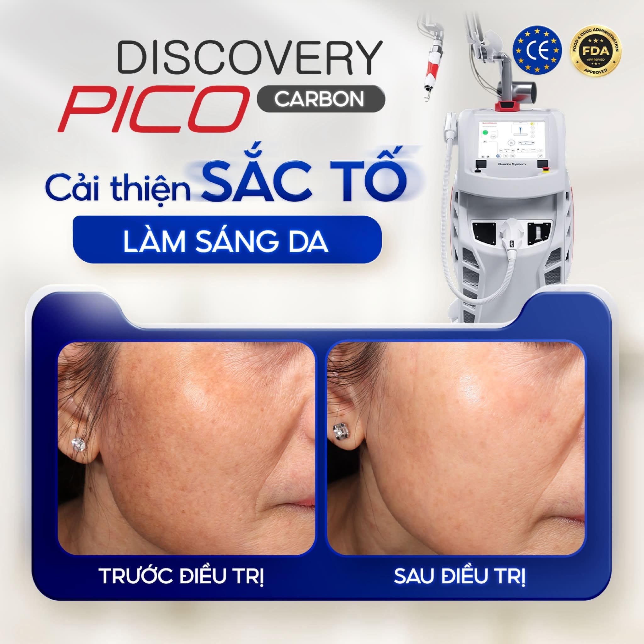 Nâng cơ trẻ hóa da tại Biên Hòa: Phòng khám nào có công nghệ xịn nhất? 6 Công nghệ laser xung ngắn hỗ trợ xử lý các vấn đề sắc tố, cải thiện tình trạng da